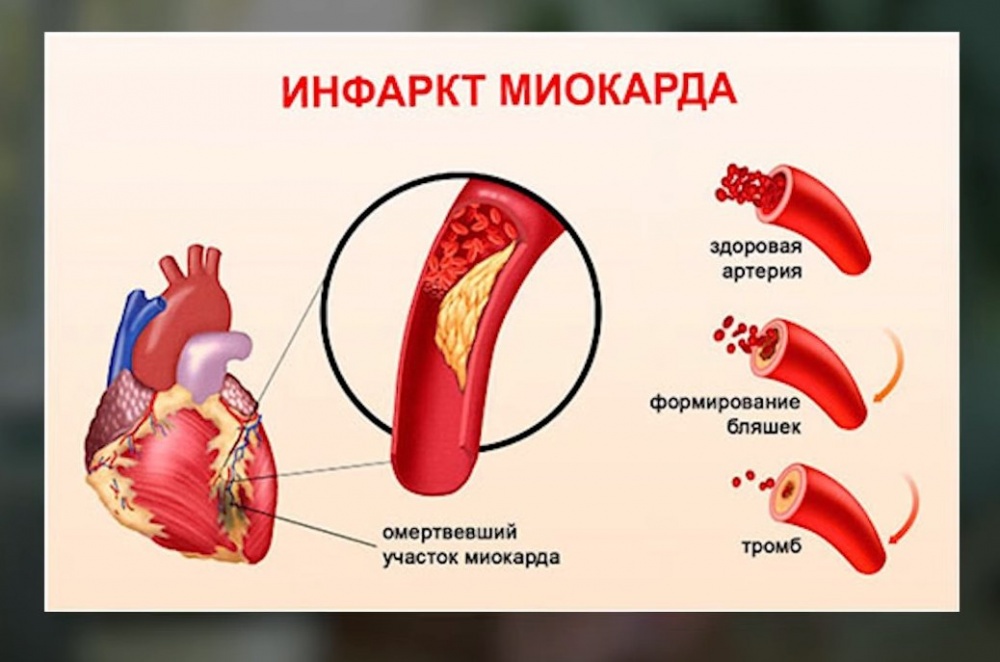 Как оказать первую помощь при инфаркте
