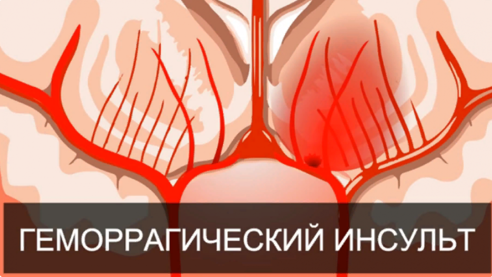 Как оказать первую помощь при инсульте