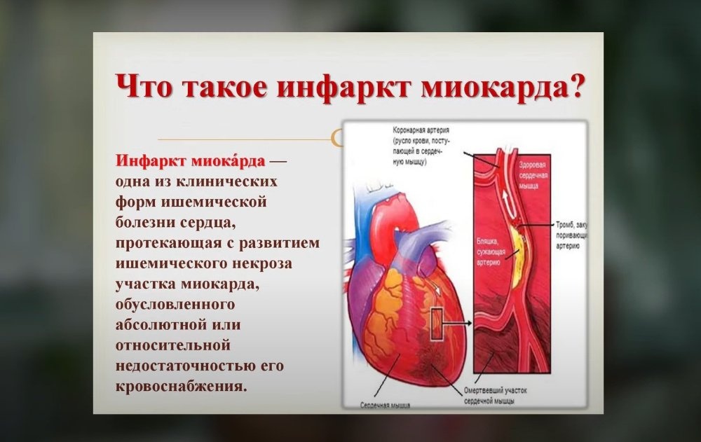 Как оказать первую помощь при инфаркте
