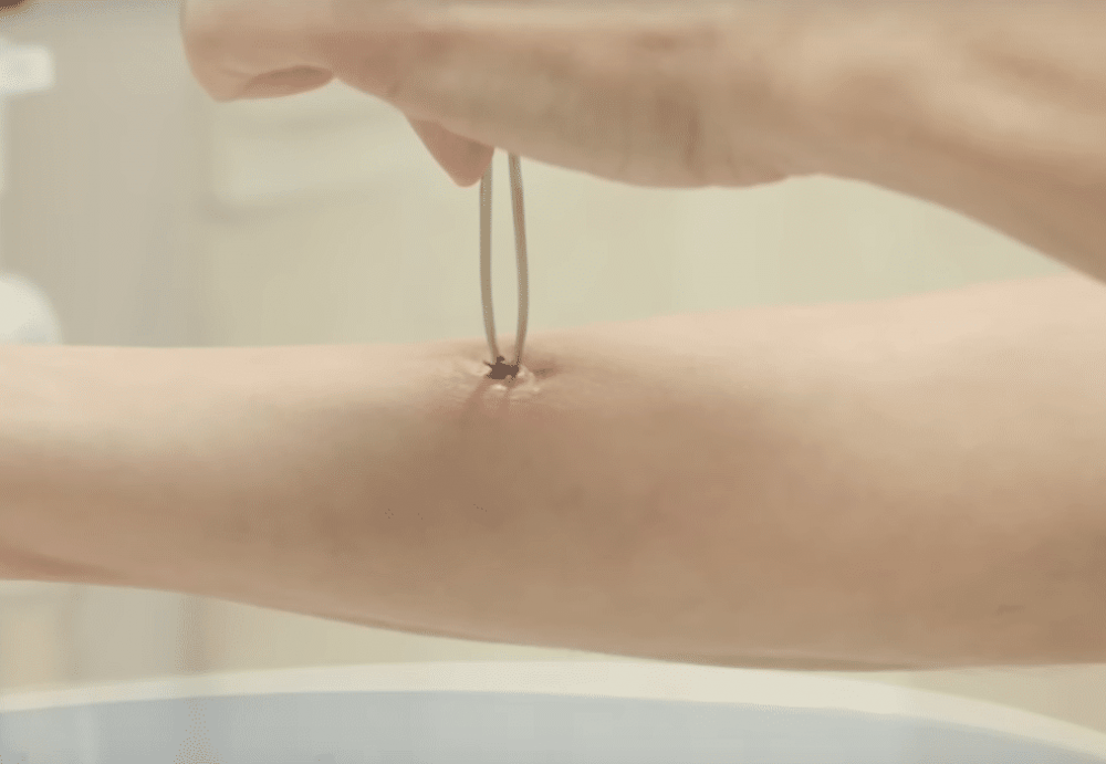 Как вытащить клеща у человека