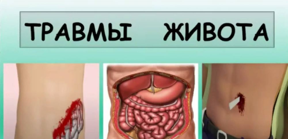 Как оказать первую помощь при травмах живота