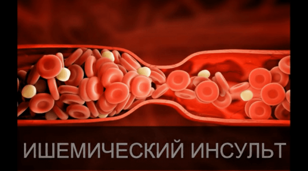 Как оказать первую помощь при инсульте